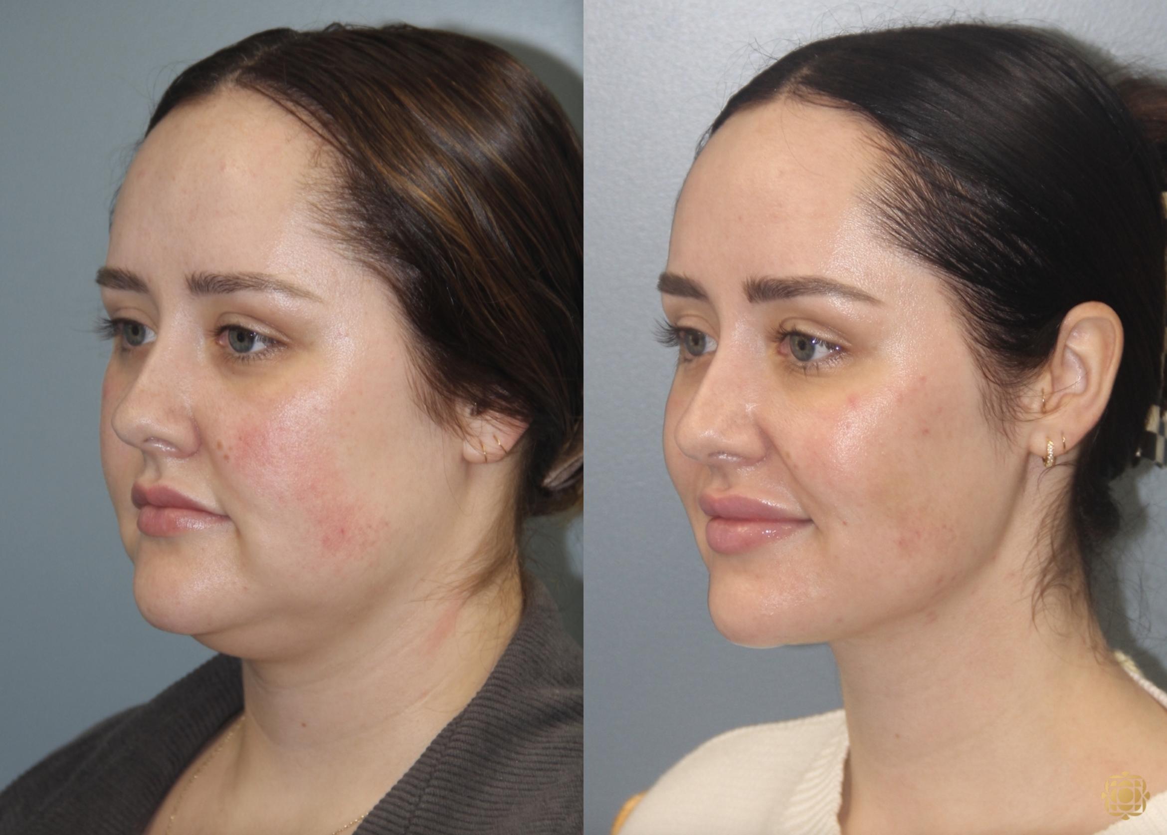 Before & After Neck Lift Case 407 Left Oblique View in Newport Beach, CA