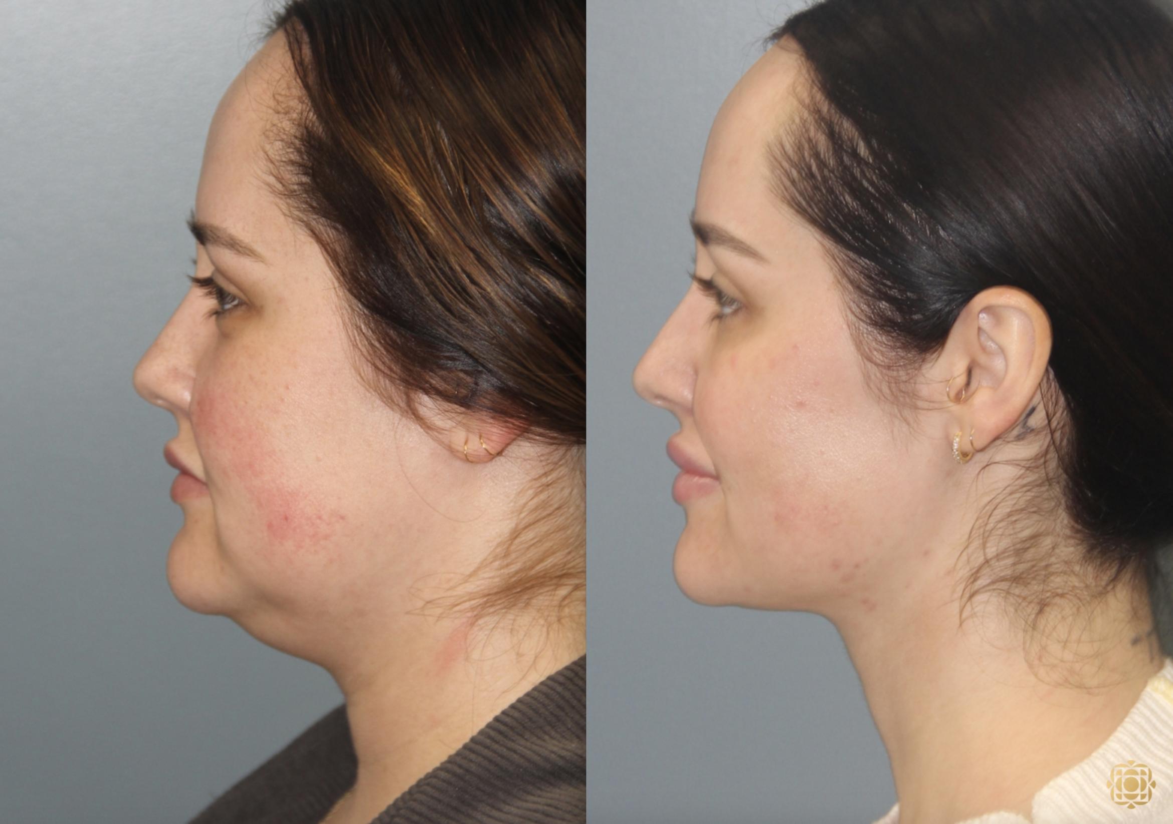 Before & After Neck Lift Case 407 Left Side View in Newport Beach, CA