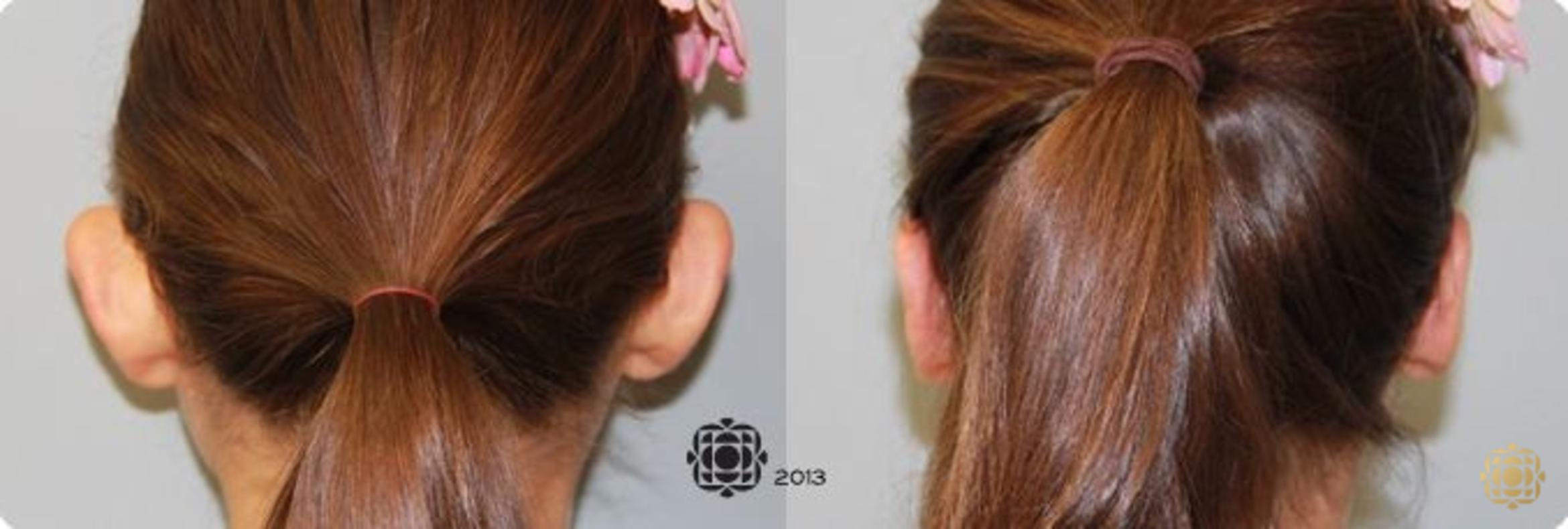 Before & After Otoplasty & Earlobe Repair Case 284 View #2 View in Newport Beach, CA