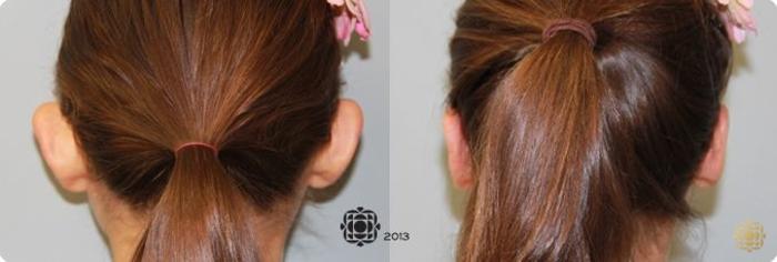 Before & After Otoplasty & Earlobe Repair Case 284 View #2 View in Newport Beach, CA