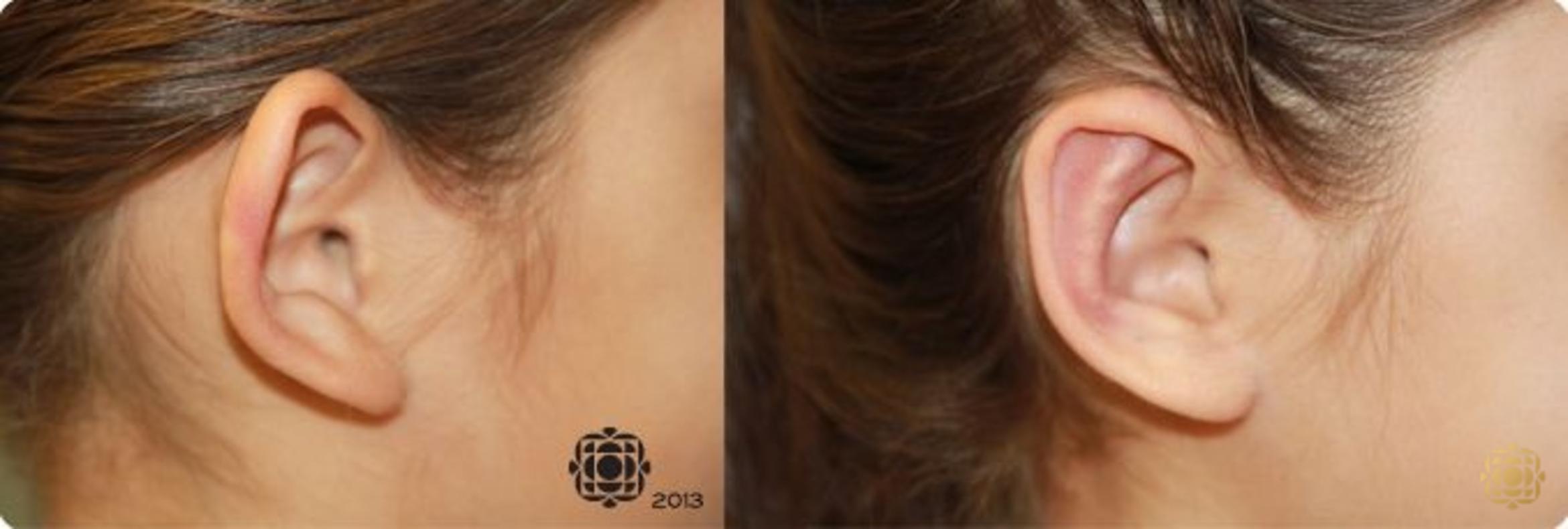 Before & After Otoplasty & Earlobe Repair Case 284 View #3 View in Newport Beach, CA