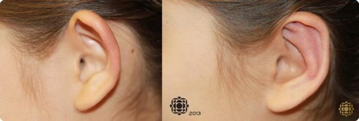 Before & After Otoplasty & Earlobe Repair Case 284 View #4 View in Newport Beach, CA