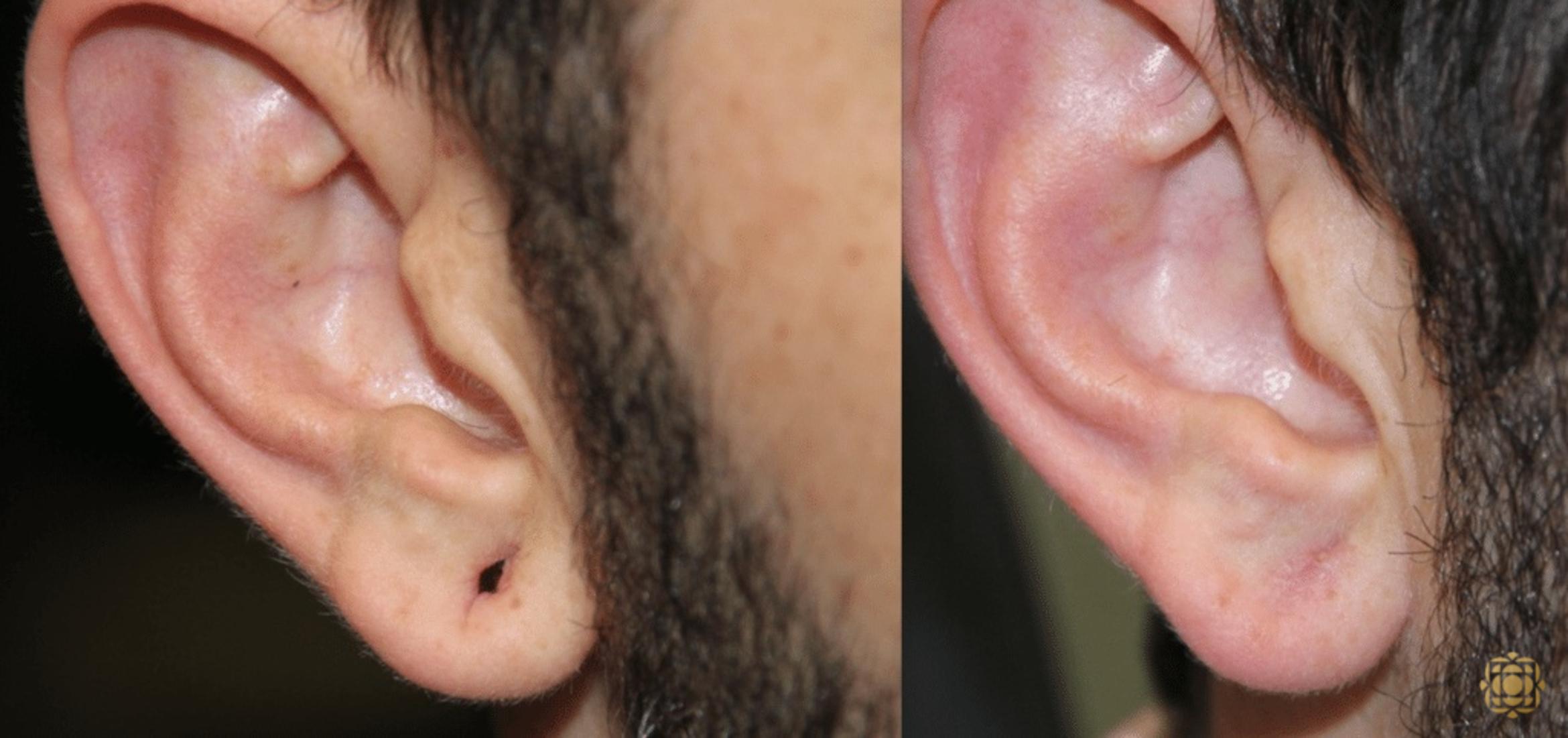 Before & After Otoplasty & Earlobe Repair Case 286 View #1 View in Newport Beach, CA