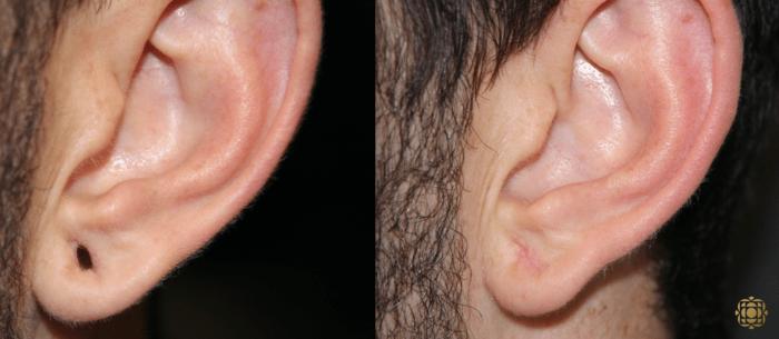 Before & After Otoplasty & Earlobe Repair Case 286 View #2 View in Newport Beach, CA