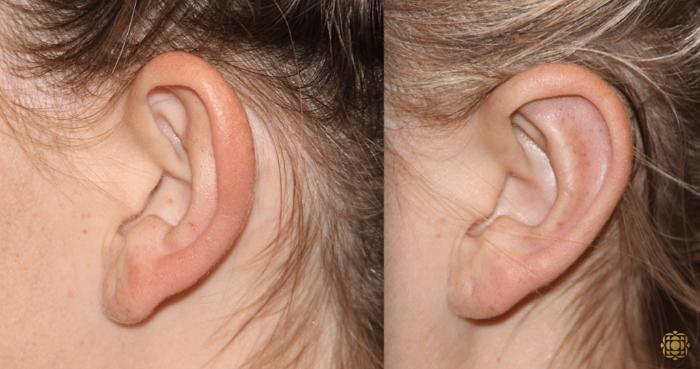 Before & After Otoplasty & Earlobe Repair Case 287 View #2 View in Newport Beach, CA