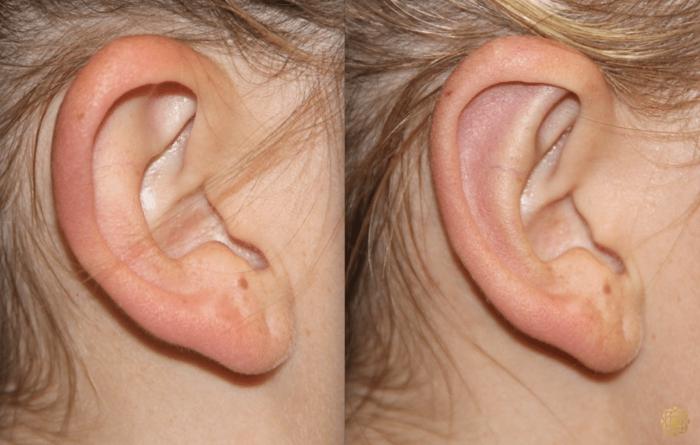Before & After Otoplasty & Earlobe Repair Case 287 View #3 View in Newport Beach, CA