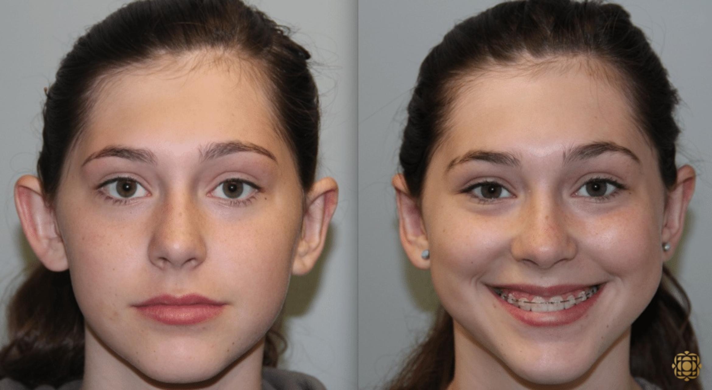 Before & After Otoplasty & Earlobe Repair Case 288 View #1 View in Newport Beach, CA