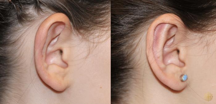 Before & After Otoplasty & Earlobe Repair Case 288 View #2 View in Newport Beach, CA