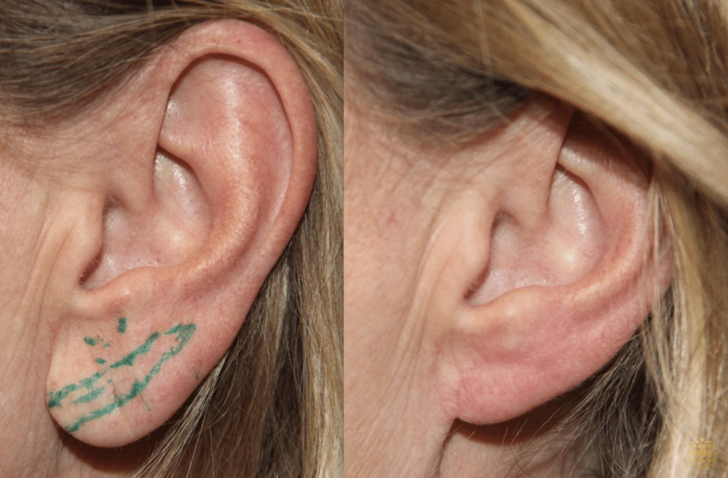 Before & After Otoplasty & Earlobe Repair Case 290 View #1 View in Newport Beach, CA