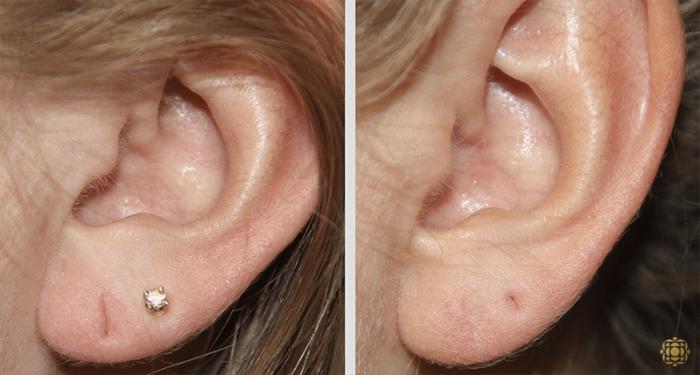 Before & After Otoplasty & Earlobe Repair Case 290 View #2 View in Newport Beach, CA