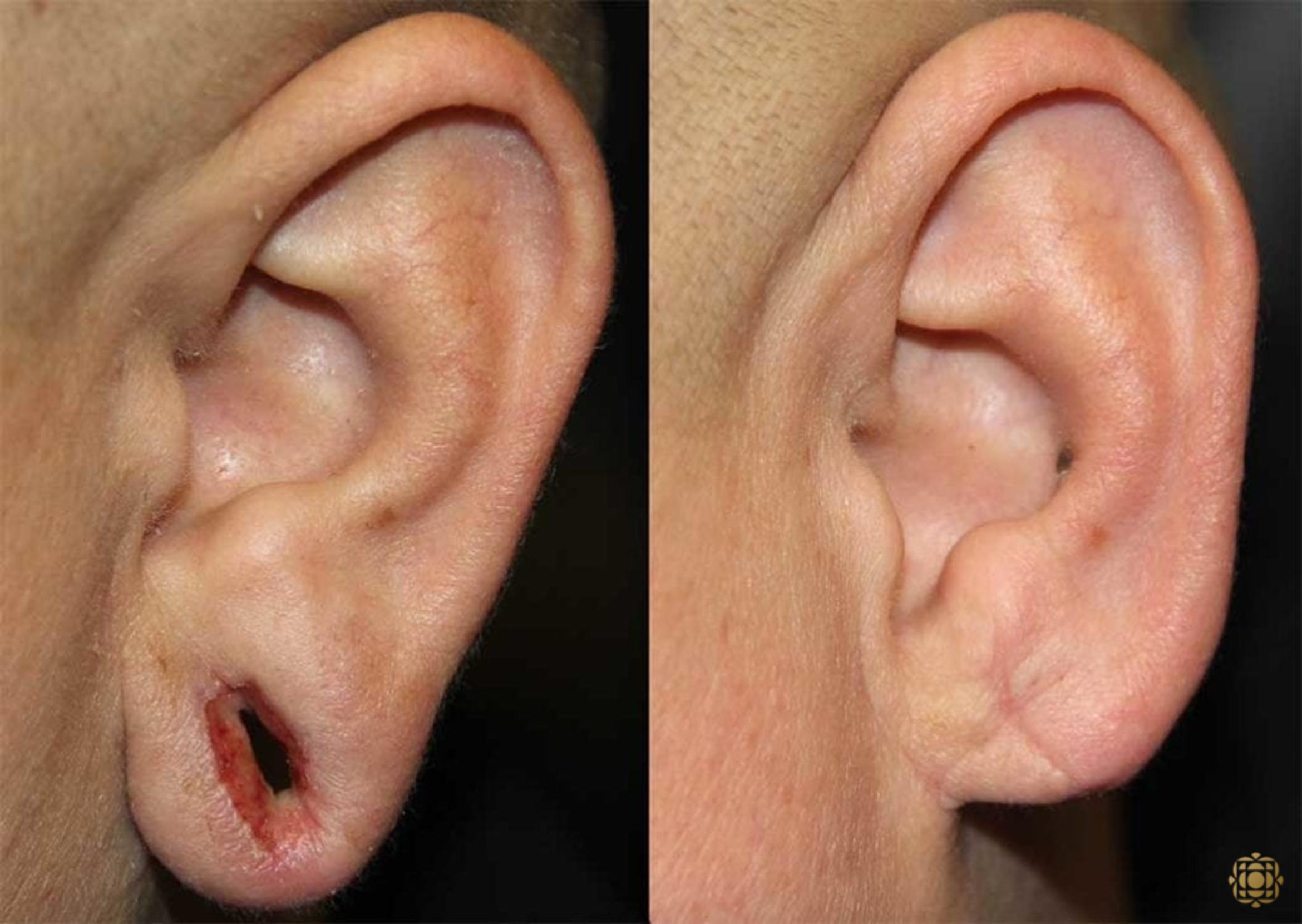 Before & After Otoplasty & Earlobe Repair Case 292 Left Side View in Newport Beach, CA