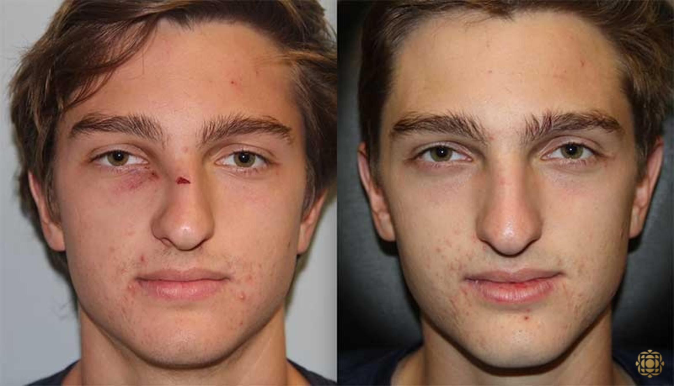 Before & After Reconstruction Case 294 View #1 View in Newport Beach, CA