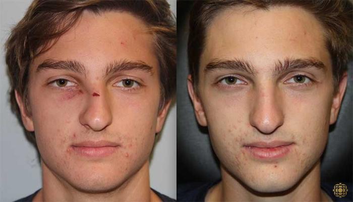 Before & After Reconstruction Case 294 View #1 View in Newport Beach, CA