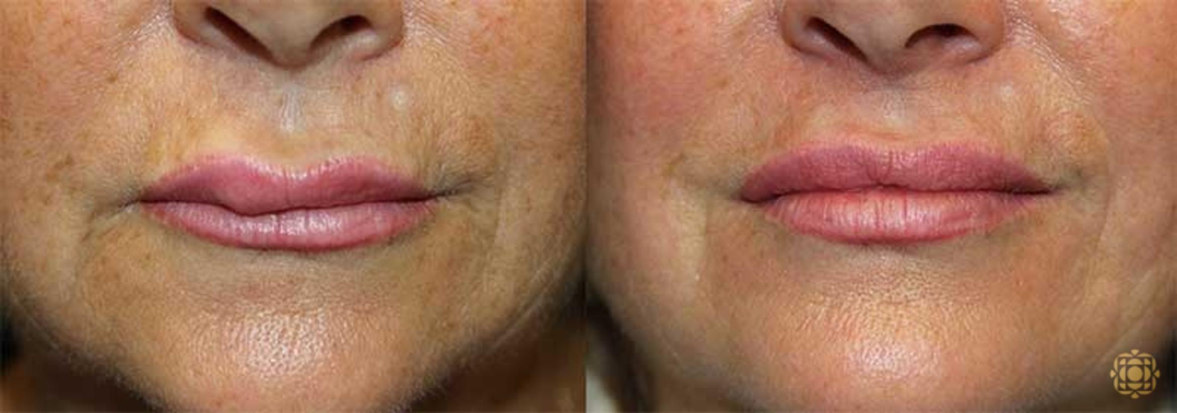 Before & After Reconstruction Case 295 View #1 View in Newport Beach, CA