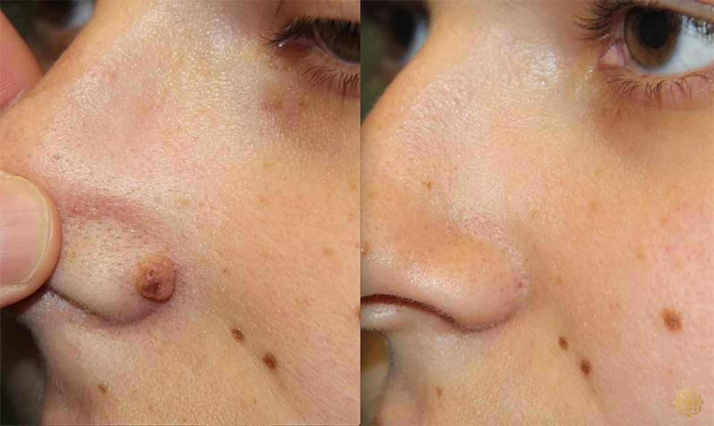 Before & After Reconstruction Case 296 View #1 View in Newport Beach, CA