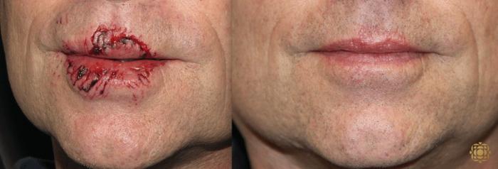 Before & After Reconstruction Case 298 View #1 View in Newport Beach, CA