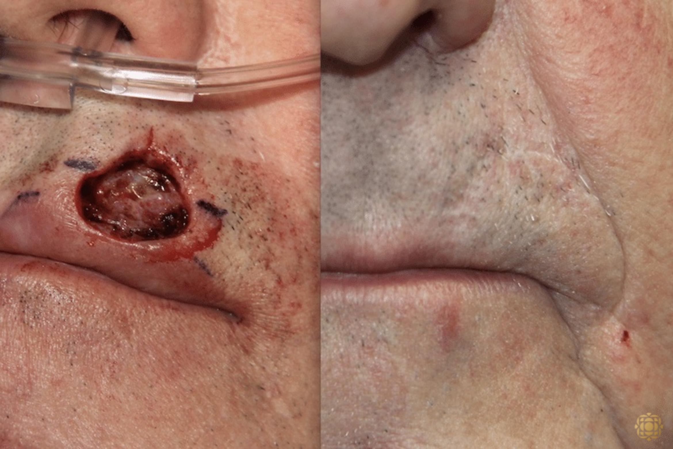 Before & After Reconstruction Case 299 View #1 View in Newport Beach, CA