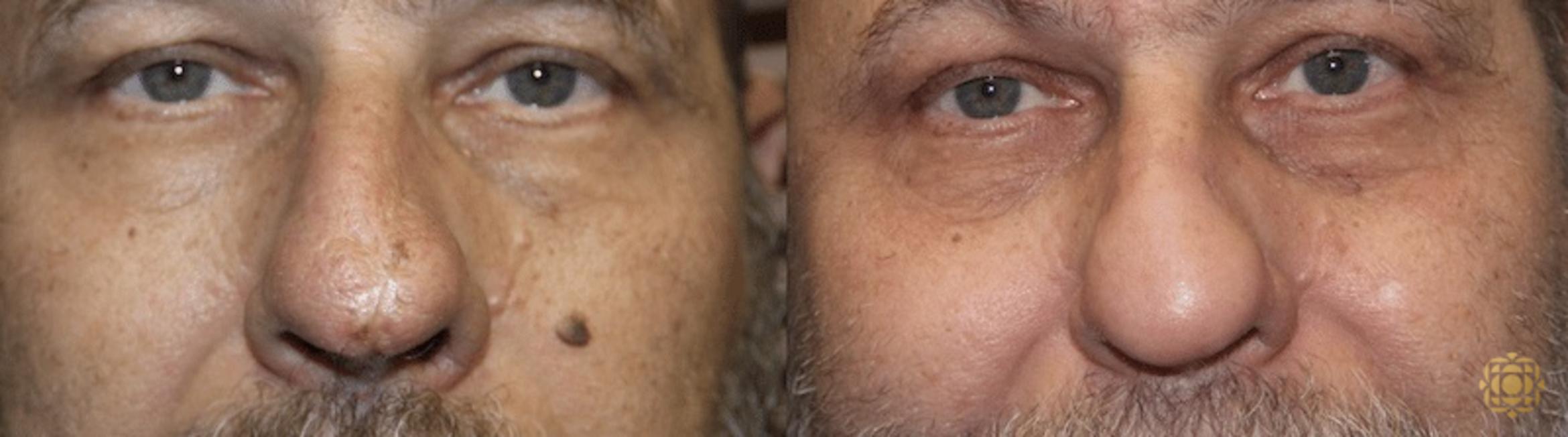 Before & After Reconstruction Case 300 View #1 View in Newport Beach, CA