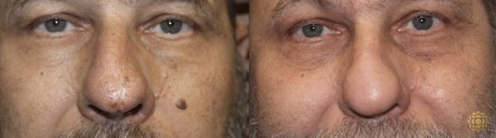 Before & After Reconstruction Case 300 View #1 View in Newport Beach, CA