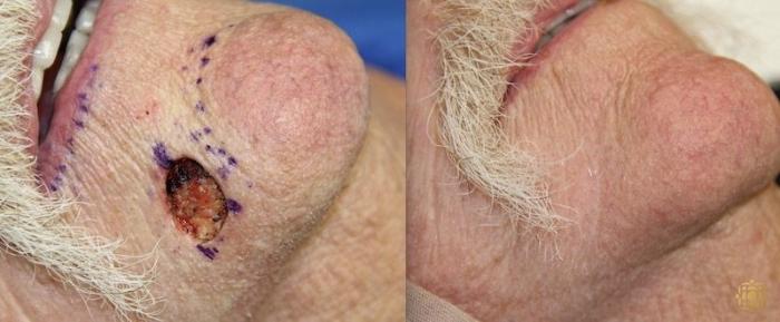 Before & After Reconstruction Case 301 View #1 View in Newport Beach, CA