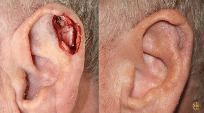 Before & After Reconstruction Case 302 View #1 View in Newport Beach, CA