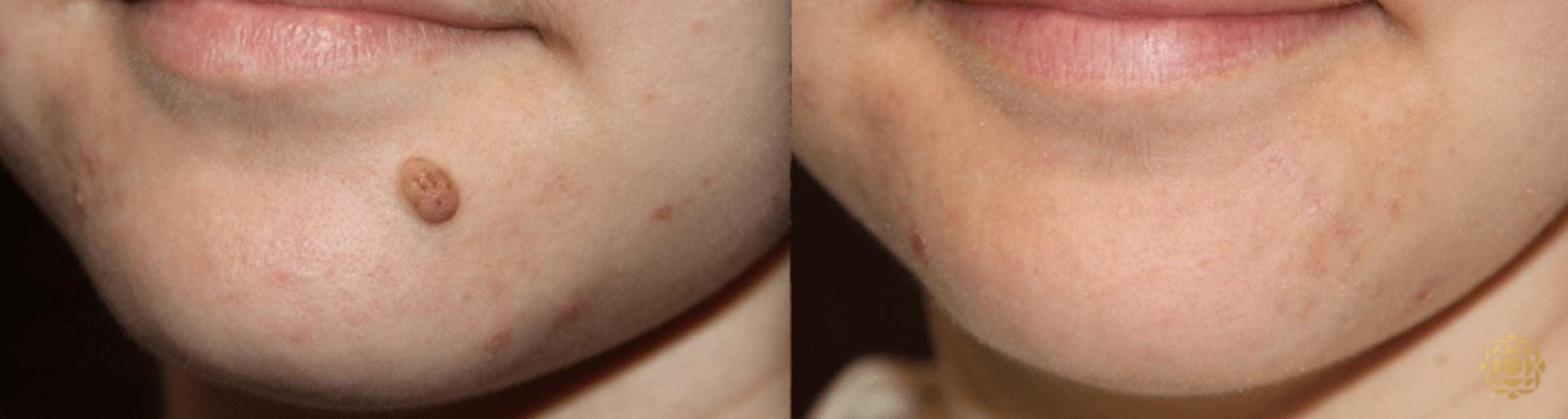 Before & After Reconstruction Case 303 View #1 View in Newport Beach, CA