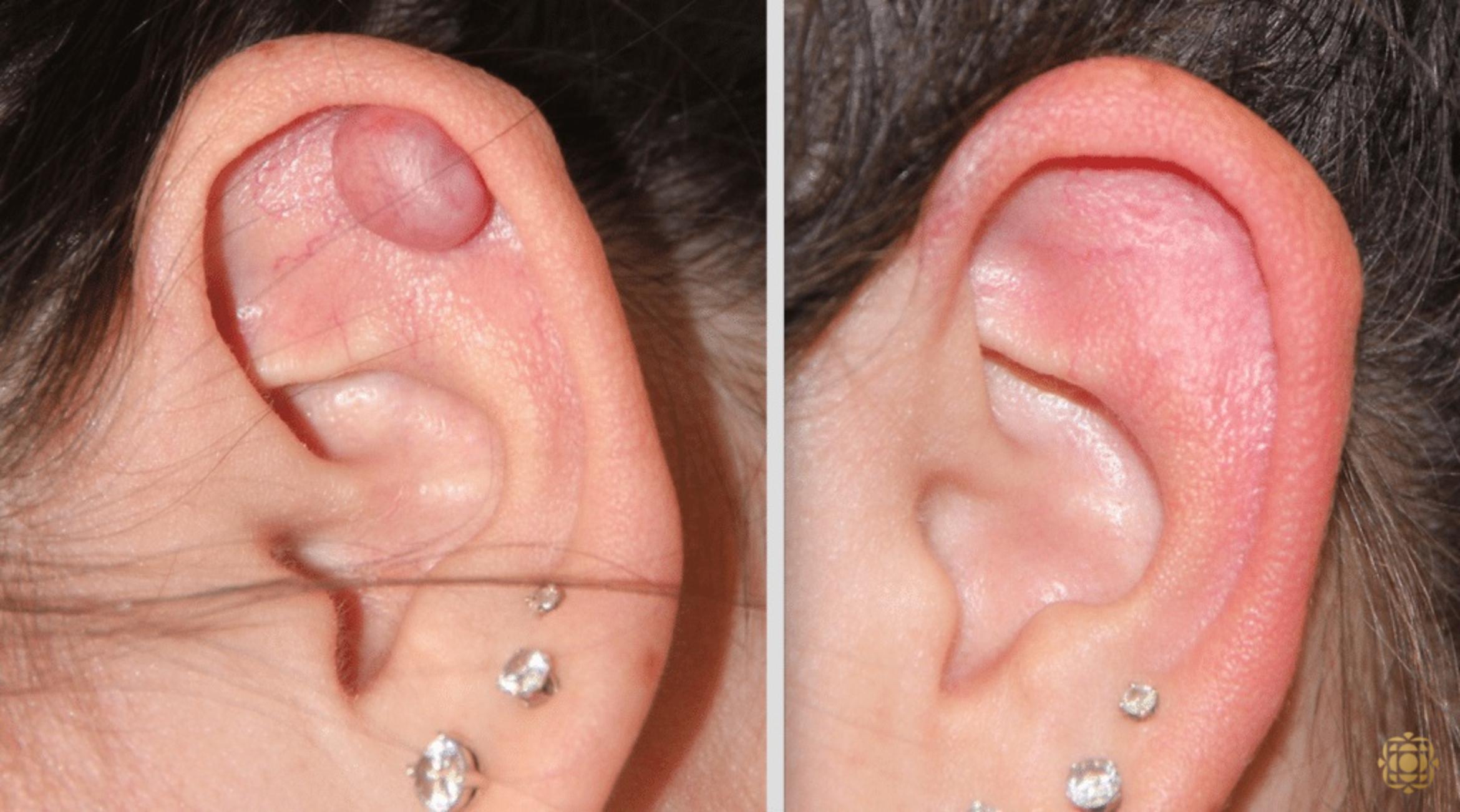 Before & After Reconstruction Case 304 View #1 View in Newport Beach, CA