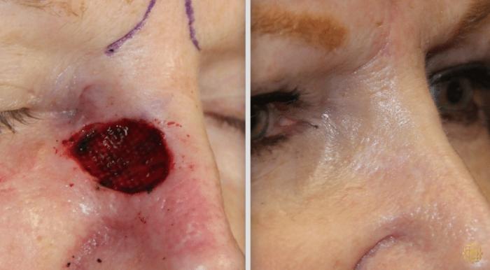 Before & After Reconstruction Case 305 View #1 View in Newport Beach, CA