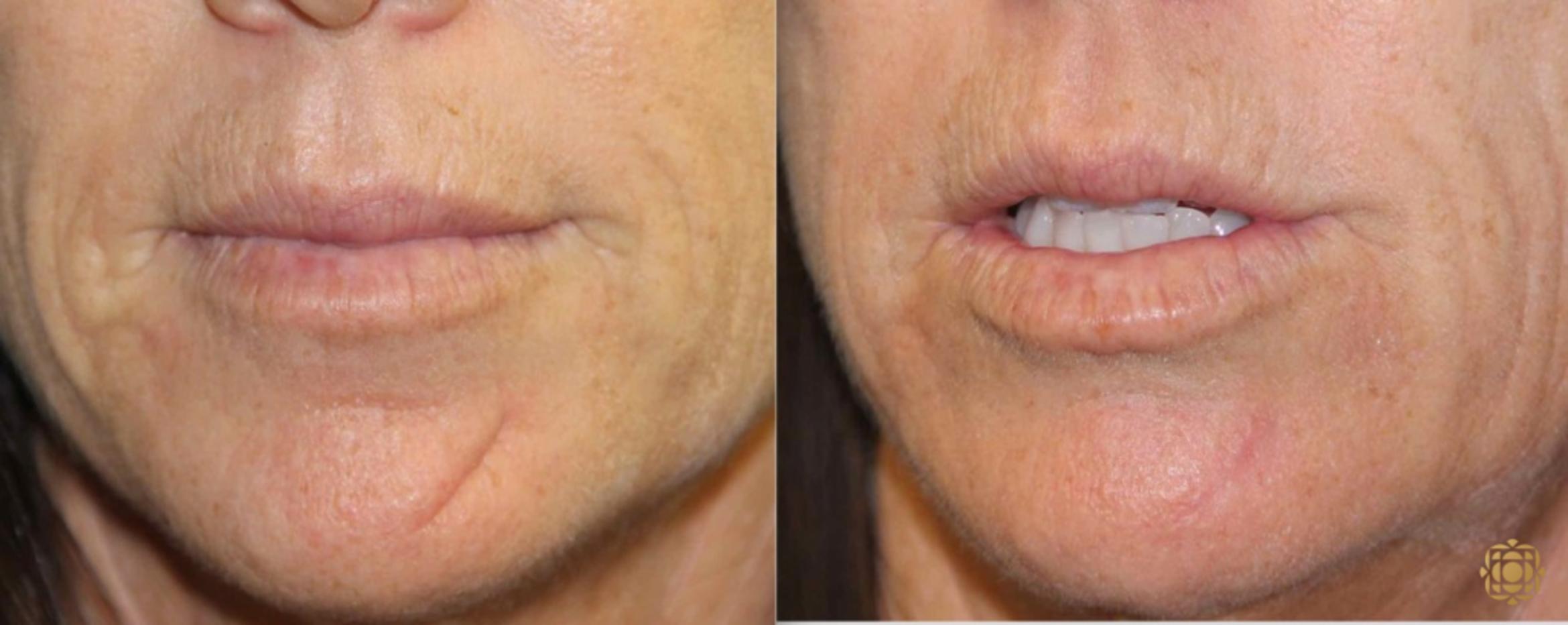 Before & After Reconstruction Case 306 View #1 View in Newport Beach, CA