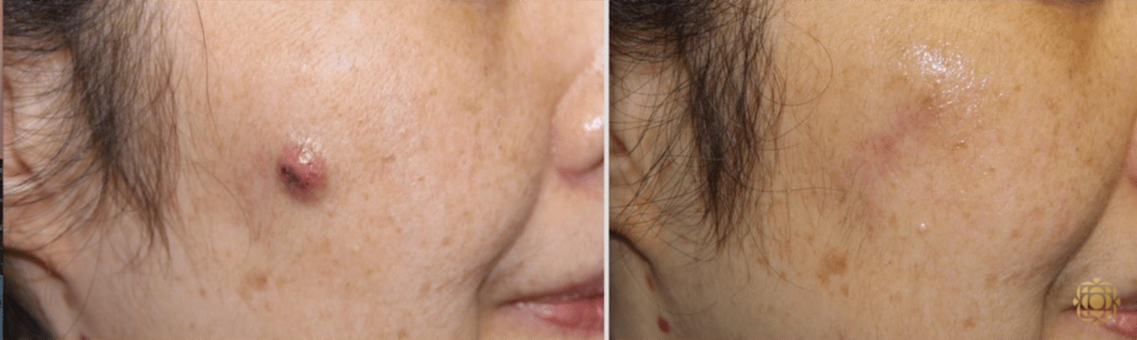 Before & After Reconstruction Case 307 View #1 View in Newport Beach, CA