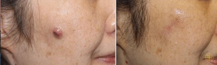 Before & After Reconstruction Case 307 View #1 View in Newport Beach, CA