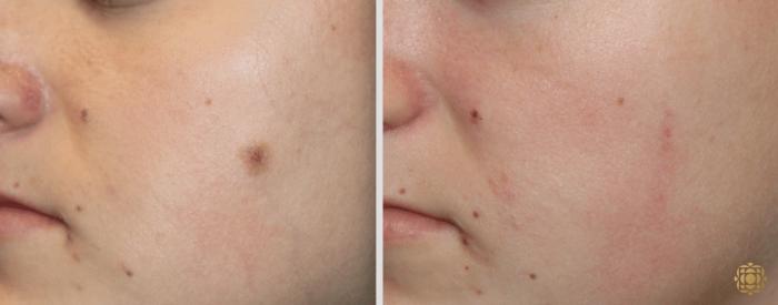 Before & After Reconstruction Case 308 View #1 View in Newport Beach, CA