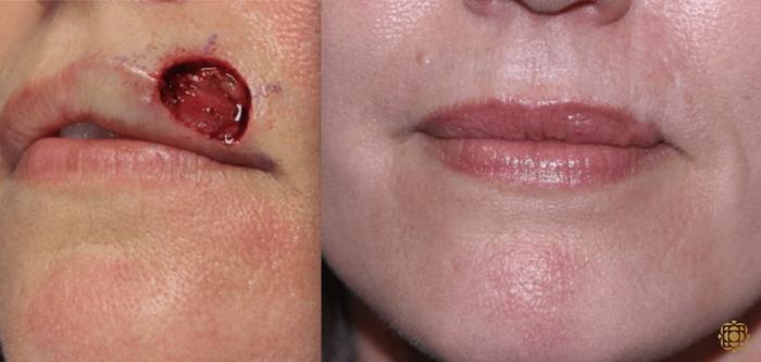 Before & After Reconstruction Case 309 View #1 View in Newport Beach, CA