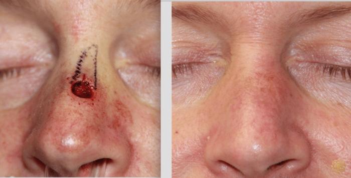 Before & After Reconstruction Case 310 View #1 View in Newport Beach, CA