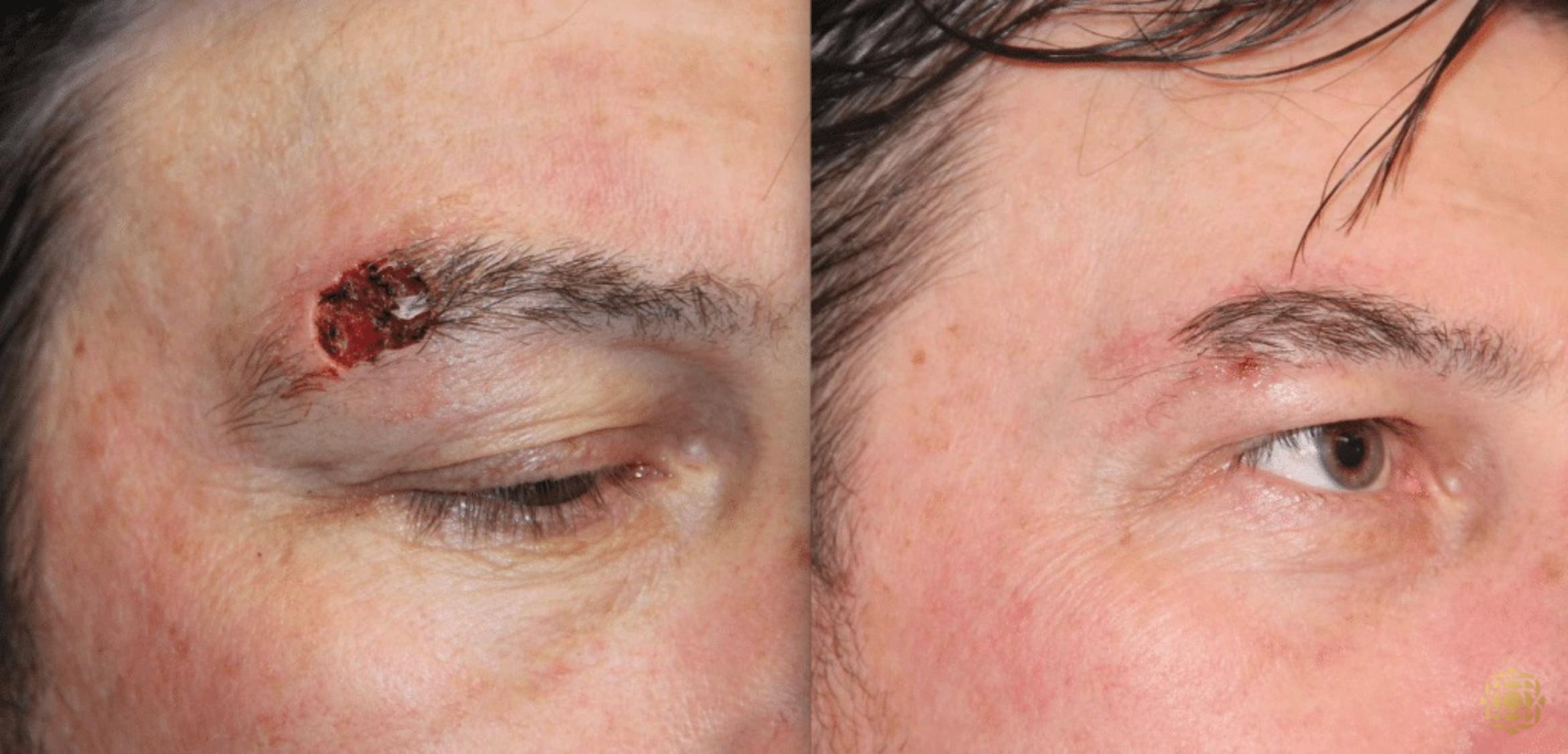 Before & After Reconstruction Case 311 View #1 View in Newport Beach, CA