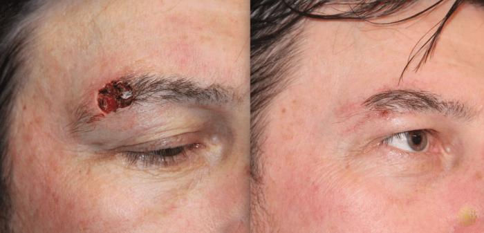 Before & After Reconstruction Case 311 View #1 View in Newport Beach, CA