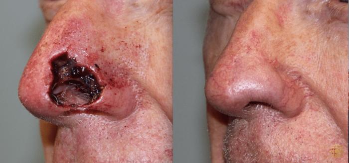 Before & After Reconstruction Case 312 View #1 View in Newport Beach, CA