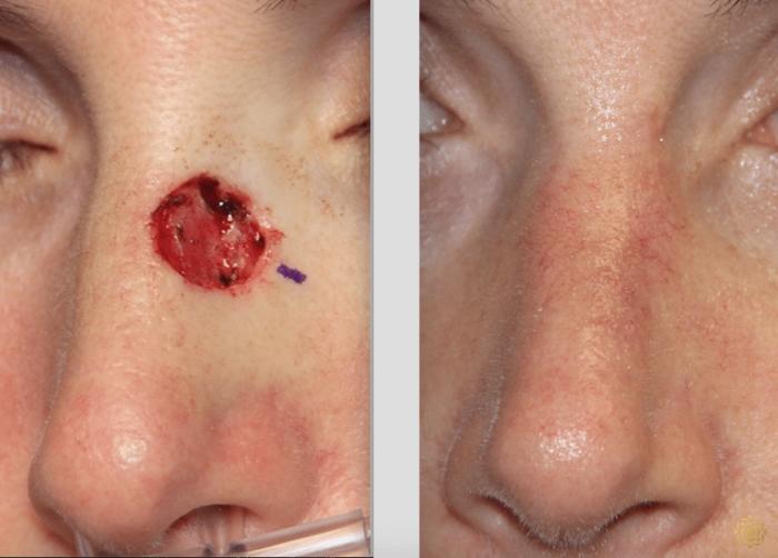 Before & After Reconstruction Case 313 View #1 View in Newport Beach, CA