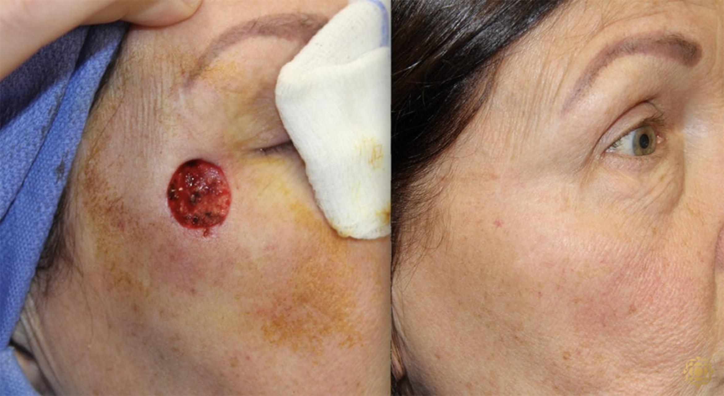 Before & After Reconstruction Case 314 View #1 View in Newport Beach, CA