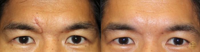 Before & After Reconstruction Case 315 View #1 View in Newport Beach, CA