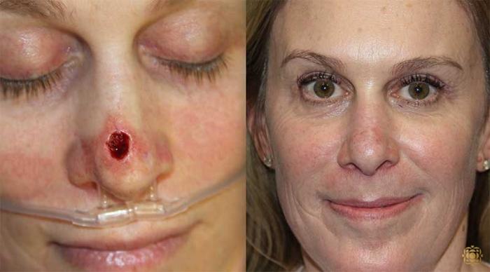 Before & After Reconstruction Case 316 View #1 View in Newport Beach, CA