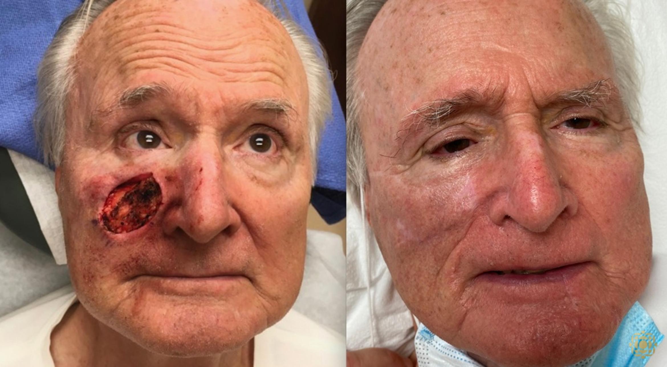 Before & After Reconstruction Case 317 View #1 View in Newport Beach, CA