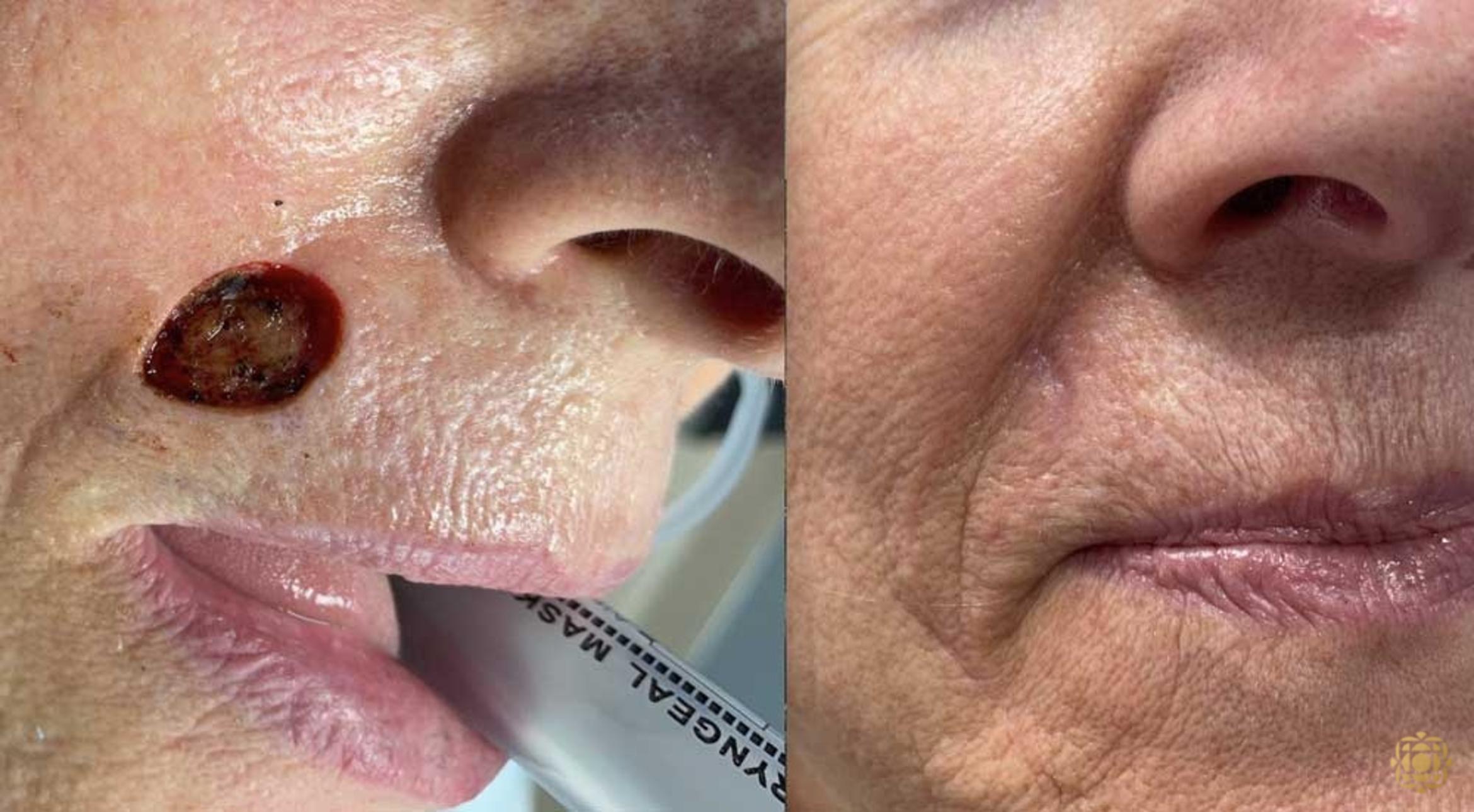 Before & After Reconstruction Case 318 View #1 View in Newport Beach, CA