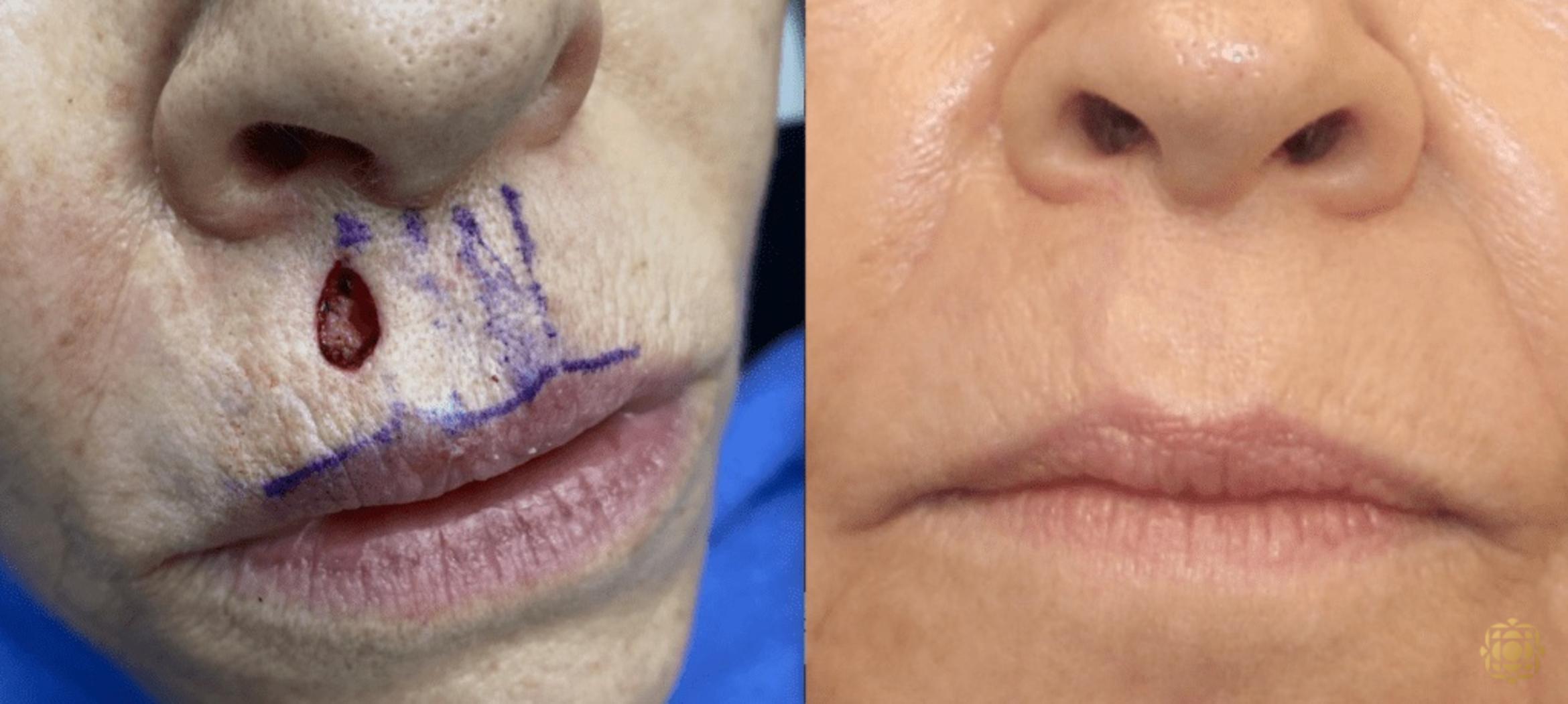 Before & After Reconstruction Case 319 View #1 View in Newport Beach, CA