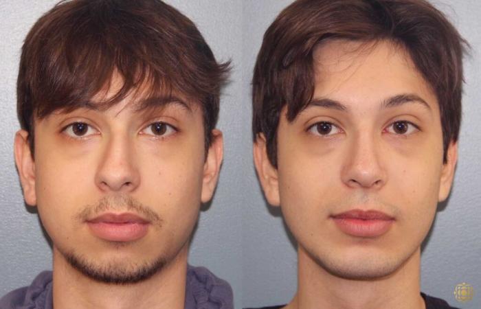 Before & After Rhinoplasty Case 109 Front View in Newport Beach, CA