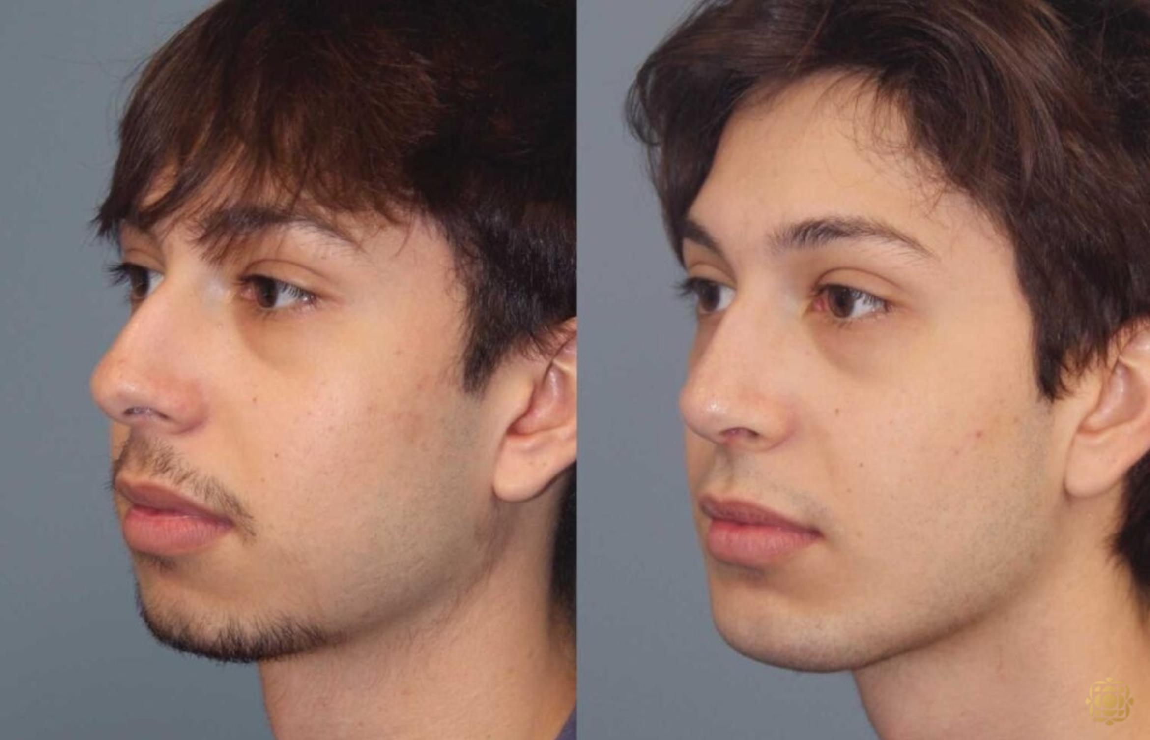 Before & After Rhinoplasty Case 109 Left Oblique View in Newport Beach, CA