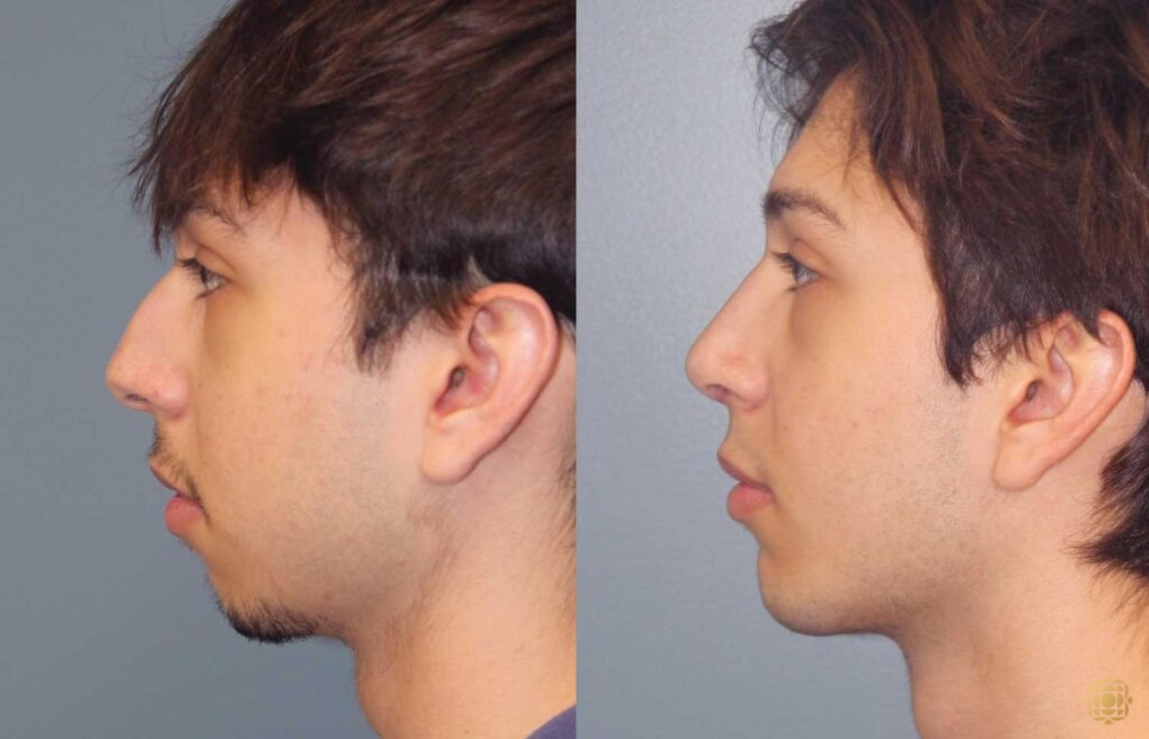 Before & After Rhinoplasty Case 109 Left Side View in Newport Beach, CA