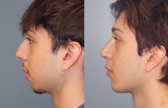 Before & After Rhinoplasty Case 109 Left Side View in Newport Beach, CA