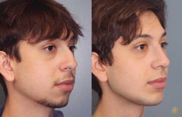 Before & After Rhinoplasty Case 109 Right Oblique View in Newport Beach, CA