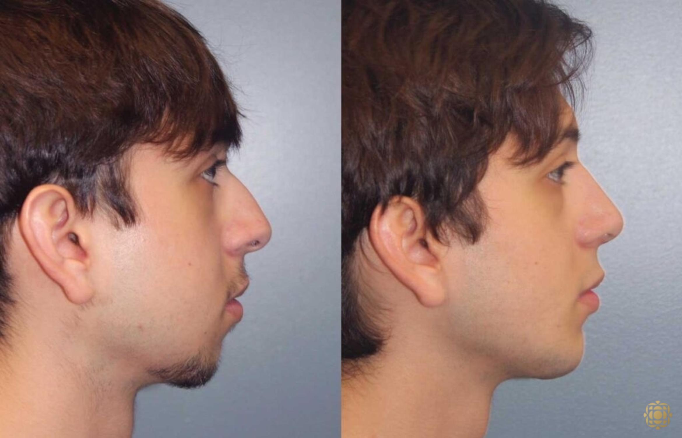 Before & After Rhinoplasty Case 109 Right Side View in Newport Beach, CA